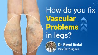 Vascular Problems by Dr. Ravul Jindal