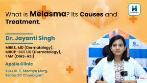 Melasma: Causes and Treatment