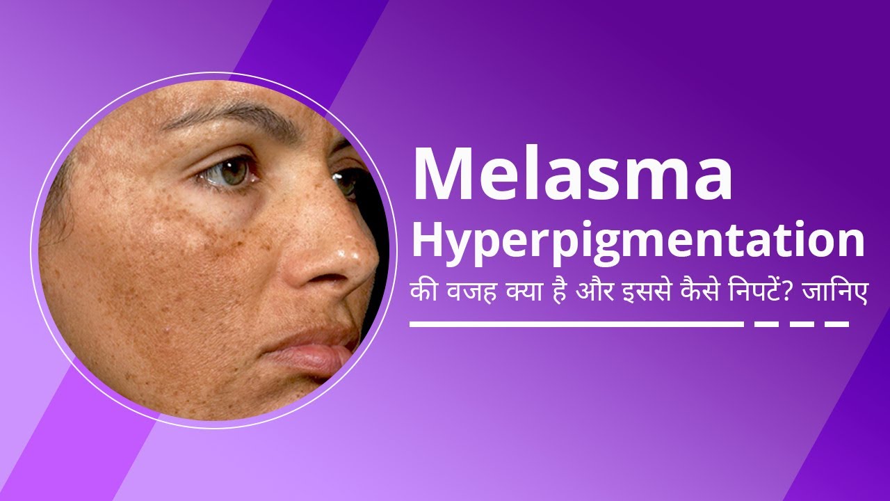 Melasma