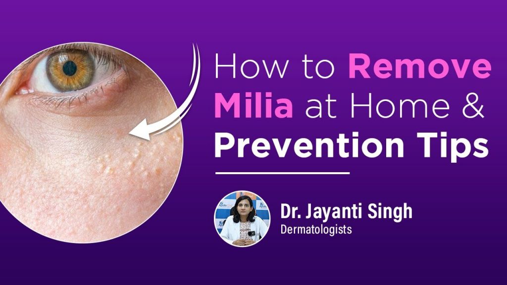 Milia: How do I get rid of milia on the Face?