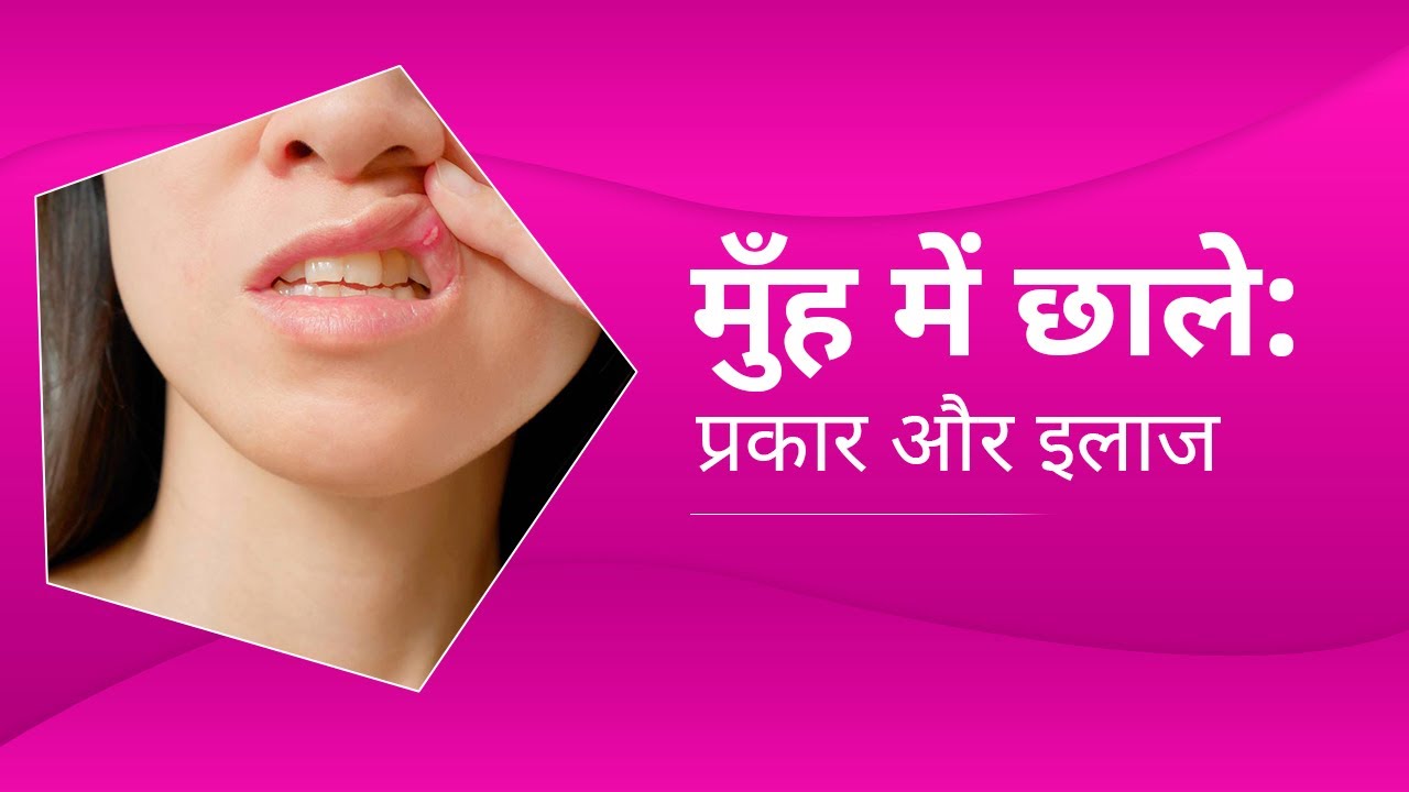 Mouth Ulcer Treatment