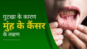 Mouth Cancer Treatment & Symptoms | मुंह का कैंसर कैसे ठीक हो सकता है? | क्या मुंह के कैंसर का इलाज संभव है? | गुटखा खाने से मुंह में क्या होता है? | कैंसर के चेतावनी के संकेत?