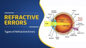 Refractive Errors of Eye & Treatment | आंखों अपवर्तन दोष क्या है?, कारण लक्षण व उपचार? | What are four major types of refractive errors of the eye? | What is the most common refractive error?