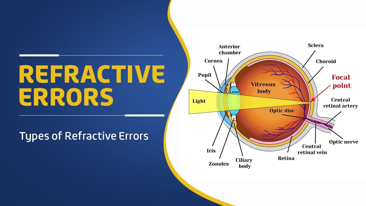 Refractive errors of eye