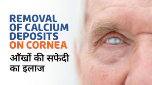 Band Shaped Keratopathy : Causes and Treatment | Removal of Calcium Deposits on Cornea | आँखों की सफेदी का इलाज