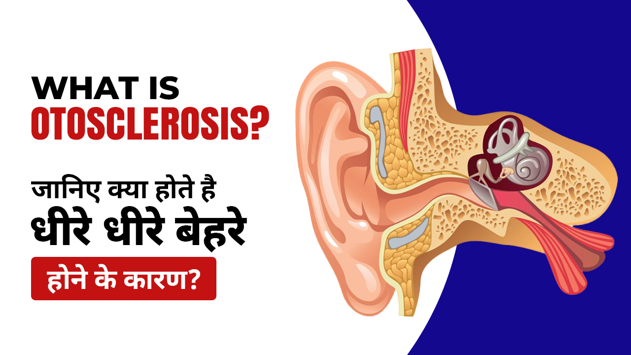 What Is Otosclerosis? Symptoms & Diagnosis