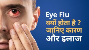 Pink Eye | Eye flu Treatment | Conjunctiva – Causes, Symptoms & Treatment | आई फ्लू कैसे होता है? | आई फ्लू कैसे ठीक करें? |  क्या सिर्फ देखने से आई फ्लू फैल सकता है? | How do you get rid of eye flu?