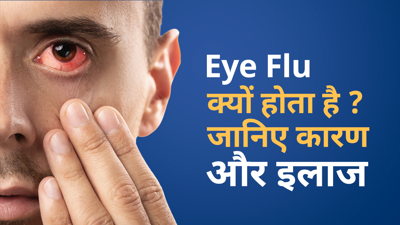 Pink eye or Eye Flu Cause & Treatment Conjunctivitis आई फ्लू का इलाज