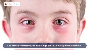 Redness of eyes in children | बच्चों की आँख में खुजली और लाल होने के कारण | आंखों में एलर्जी क्यों होती है? | What Are The Reasons For Redness In Eyes In Children? How Can It Be Prevented?